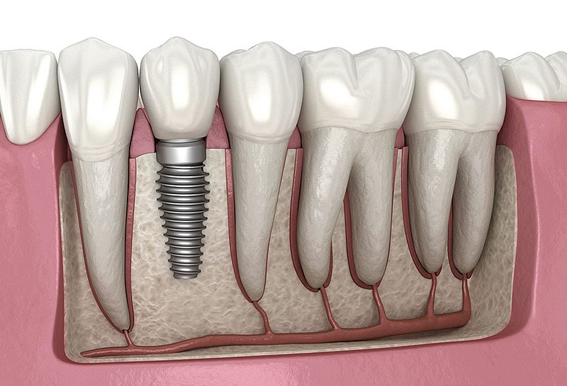 Know Your Options –Alternatives For Dental Implants 